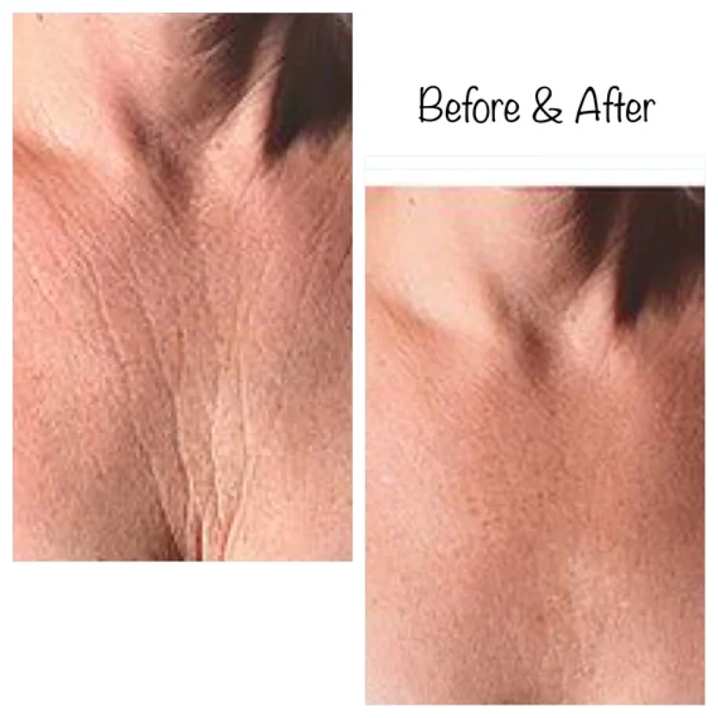 Silicone Chest Pads Before And After - Tellgrade Antiwrinkle Pads Before And After Last 1